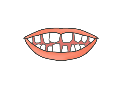 歯並びの悪い歯のイラスト