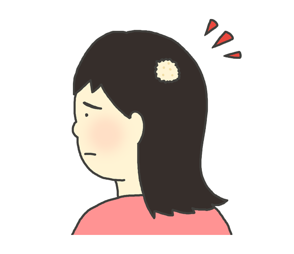 円形脱毛症（十円禿）のイラスト（女性）